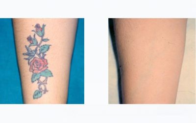 Rimozione tatuaggi con laser